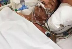 男子割草遭遇眼镜蛇咬伤手指，险象环生面临截肢危机